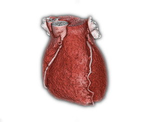 Bildmaterial: CT mit normalen Herzkranzgefäßen