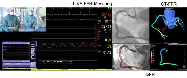 Abb 1:
„Warten auf den FFR-Abfall“. Nachtrag zum KHK-LIVE-CASE DKDT 2016. Sowohl in der QFR (Fa. Medis) aus den biplanen Angiographiedaten, als auch in der nachträglich bestimmten CT-FFR (Fa. HeartFlow) aus CT-Daten konnte korrespondierend zu den invasiv ermittelten Werten keine hämodynamische Relevanz einer visuell hochgradigen distalen RCA-Stenose nachgewiesen werden.
