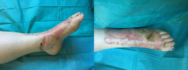 Nekrosen am Fußrücken eines adipösen Patienten nach Paravasat bei Kontrastmittelgabe bei einer Polytrauma-CT