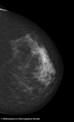 Digitale Screening-Mammografie.
