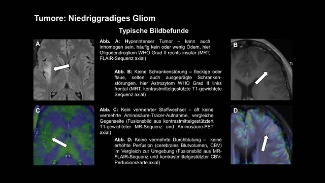 Fallbasierte Lernmaterialien am Beispiel des niedriggradigen Glioms. © Universitätsklinikum Tübingen