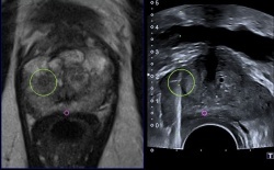56-jähriger Patient mit weiter steigendem PSA-Wert nach negativer systematischer Prostatastanze.
Nachweis eines suspekten Herdbefunds in der MRT (links), der MR/US-fusioniert gezielt gestanzt wurde
(rechts). Histologisches Ergebnis: Gleason 3 + 4