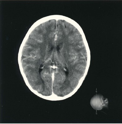 Kopf CT-Scan mit Picker IQ Premier. Aus Druckschrift: Picker. IQ CT Imaging Sytem, 1992. Bildarchiv Röntgengeräte aus dem Zentrum für das Radiologische Erbe der Niederlande (mit freundlicher Genehmigung).
